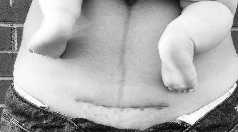 5 Tips for C-Section Recovery - Milk & Baby 